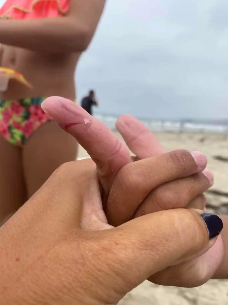 A picture of broken skin on a kid's finger after he was bit by a seagull at La Jolla Shores beach in San Diego.